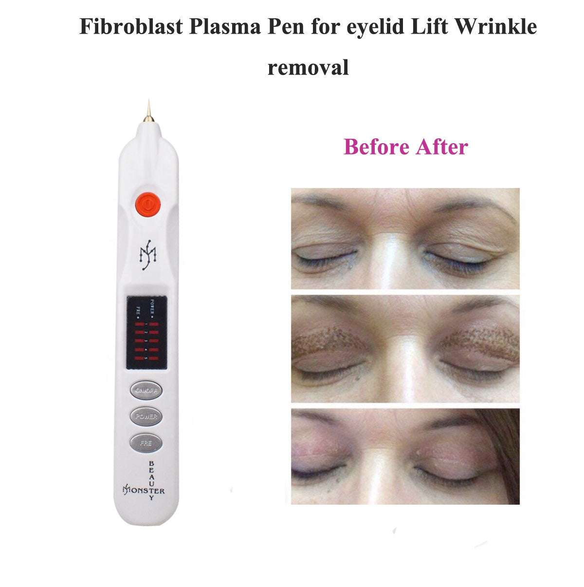 Fibroblast Plasma Pen for Face eyelid lift Wrinkle Removal Spot Tattoo Removal Rechargeable plasmapen