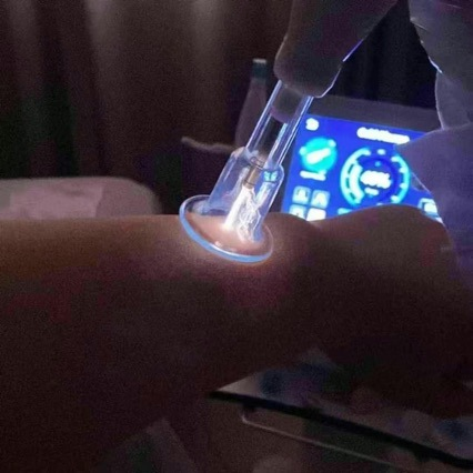 Fibroblast Cold Plasma For Wrinkle Remover Face Lift Skin Face Tightening Acne Treatment Skin Rejuvenation